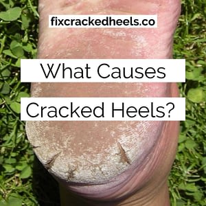 What causes cracked heels?
