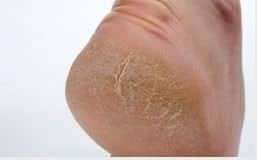 What are the main causes of cracked heels? Which medical conditions causes cracked heels?Read this to find the most common reasons your heels crack.