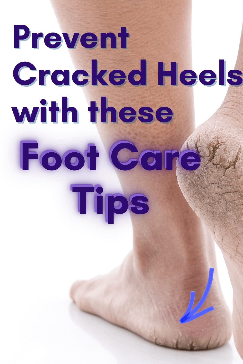 Prevent cracked heels Lots of people protect themselves by purchasing sunscreen, lip protectants and sunglasses. But many will forget to look after two of the most important and neglected parts of the body – the feet.