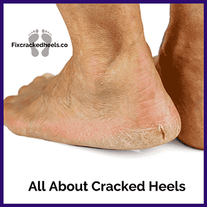 Everything you wanted to know about cracked heels.