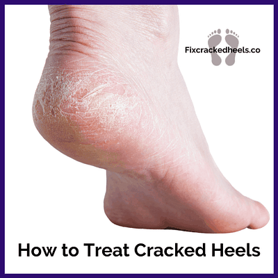 Learn tips and tricks on how to treat cracked heels and heel fissures